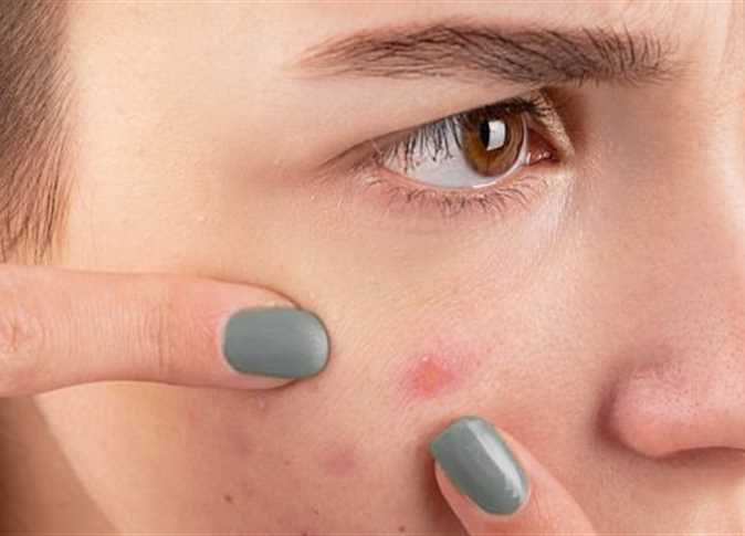 عادات يومية سبب في ظهور البثور والتجاعيد